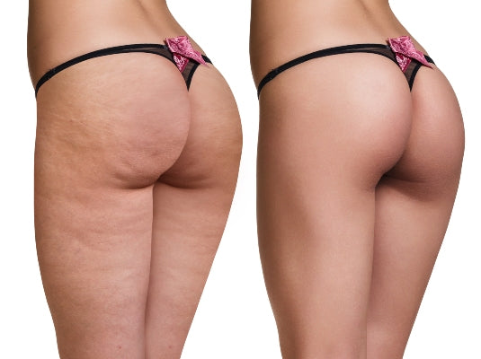 Cellulite